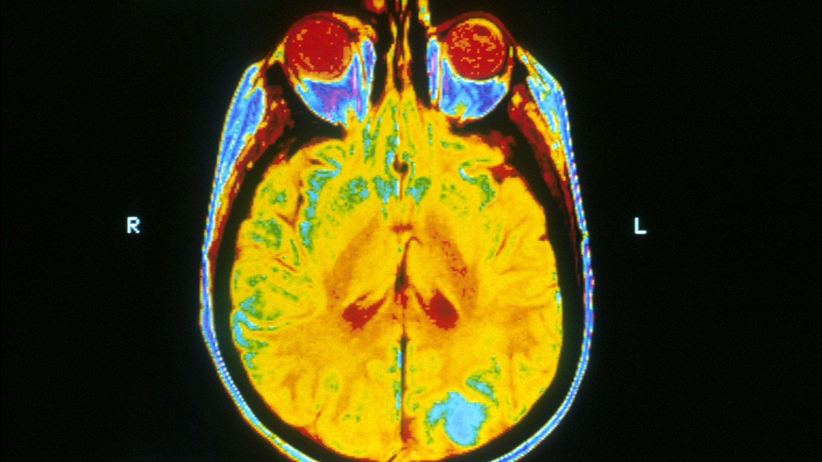 Illustrative magnetic resonance imaging scan of a human brain